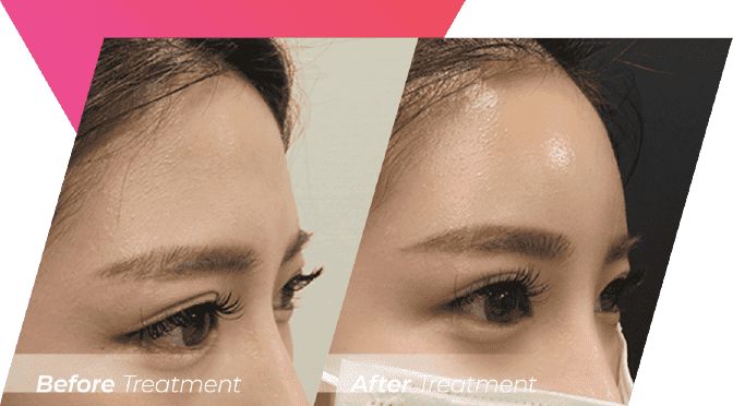 Skin Rejuvenate Injections 03