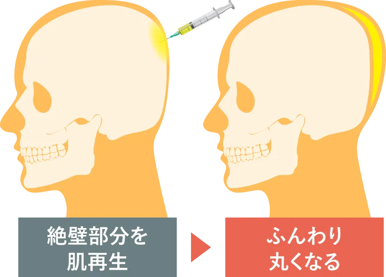 PRP注射で”後頭部を形成する”とは