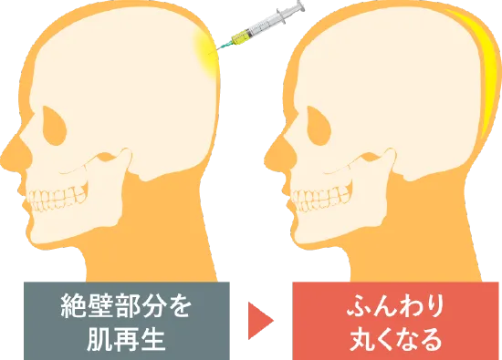 PRP注射で”後頭部を形成する”とは