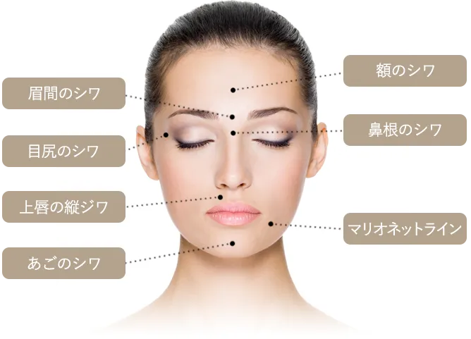 ボトックス注入の適応部位