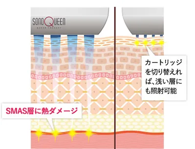 SMAS層に熱ダメージ