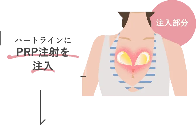 ハートラインにPRP注射を注入