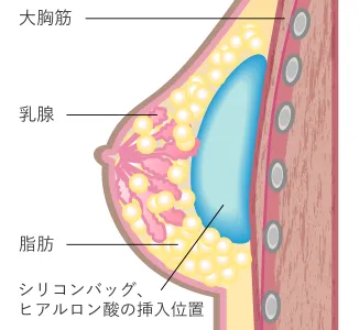 従来の豊胸術