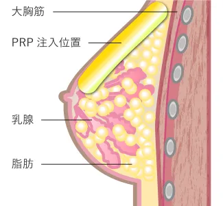 PRP注射