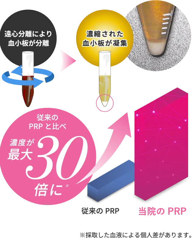 しわ取りPRP注射に使用するPRPはとにかく濃い！