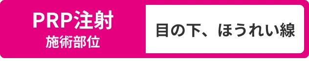 PRP注射施術部位：目の下、ほうれい線