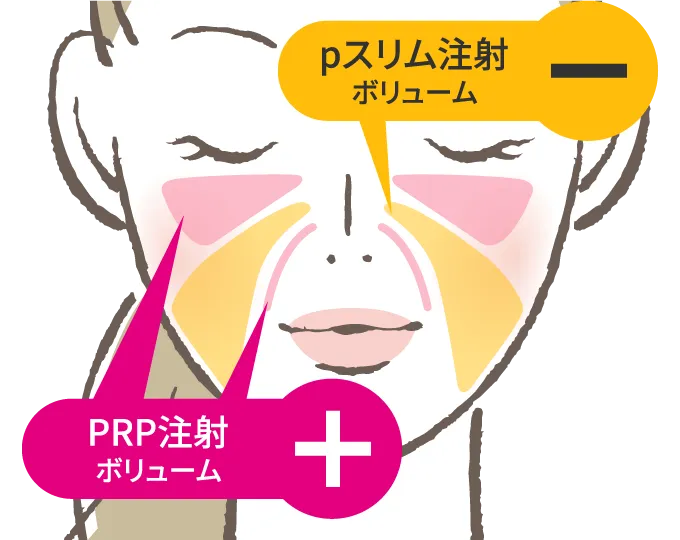 PRP注射施術部位：目の下、ほうれい線