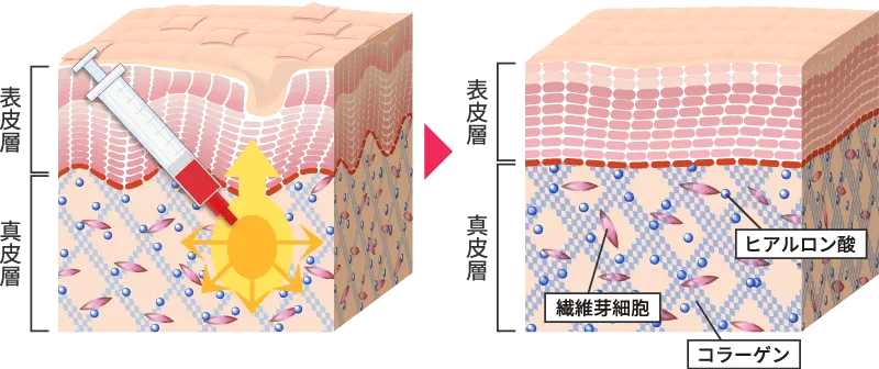 持続効果は5年以上！