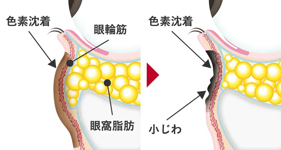 色素沈着や小ジワが治らない