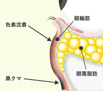 Step 1 目の下のふくらみに加えて、茶クマや黒クマ（影クマ）を伴ったクマ