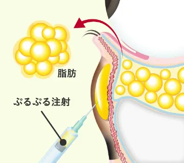 Step 2 下まぶたの裏側（結膜）から余分な脂肪を取り、同時にクマの原因部にPRP注射を行う