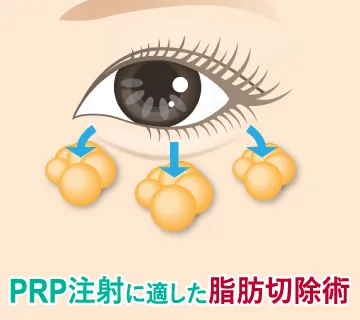 PRP注射に適した脂肪切除術