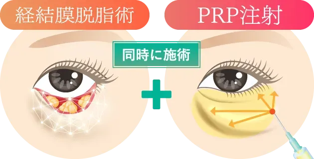 経結膜脱脂術とPRP注射を同時に施術