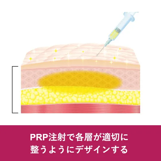 PRP注射で各層が適切に整うようにデザインする