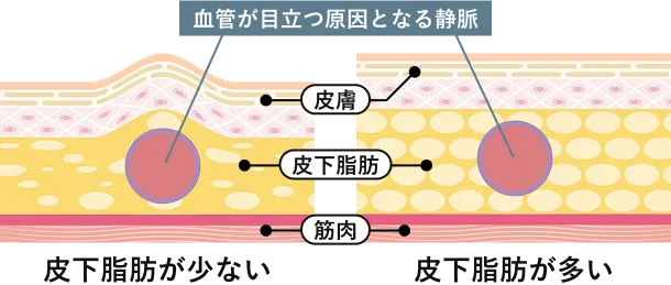 原因1:加齢による皮膚の薄化