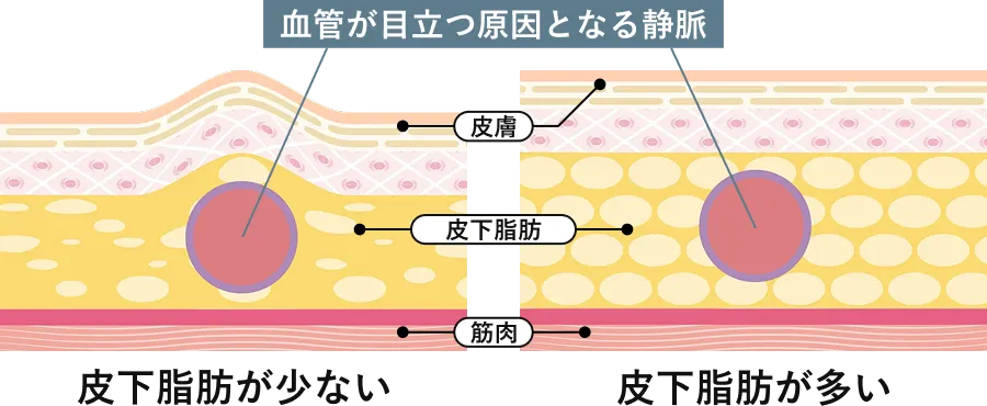 原因1:加齢による皮膚の薄化