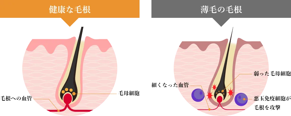 薄毛の毛根の特徴