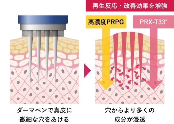 ダーマペンで真皮に微細な穴をあける。穴からより多くの成分が浸透