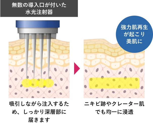 無数の導入口が付いた水光注射器:吸引しながら注入するため、しっかり深層部に届きます。⇒ニキビ跡やクレーター肌でも均一に浸透