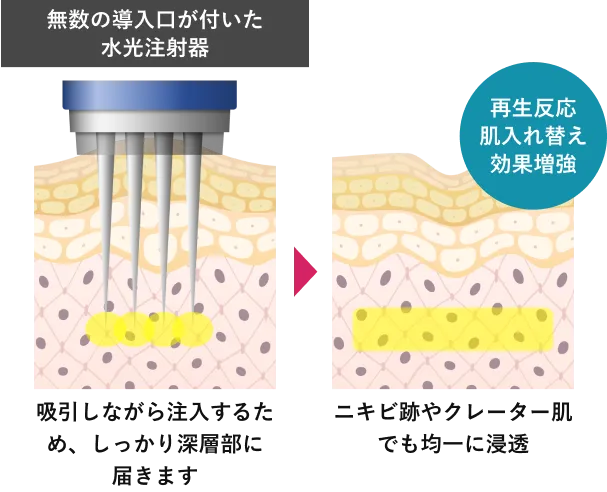 無数の導入口が付いた水光注射器⇒再生反応肌入れ替え効果増強