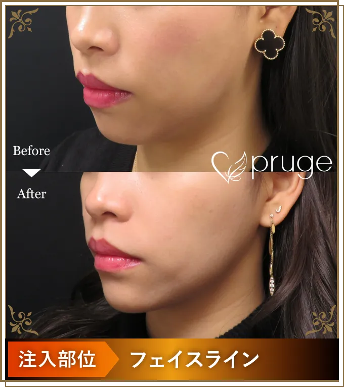 Before After