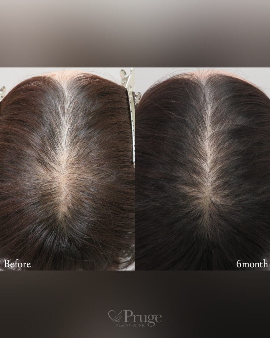 p-Scalp